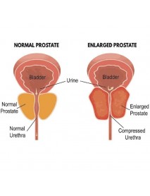 próstata normal